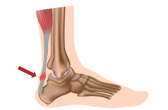 Achilles Tendinitis: Achilles Tendon Pain, Treatment